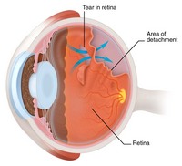 Retinal-Detachment